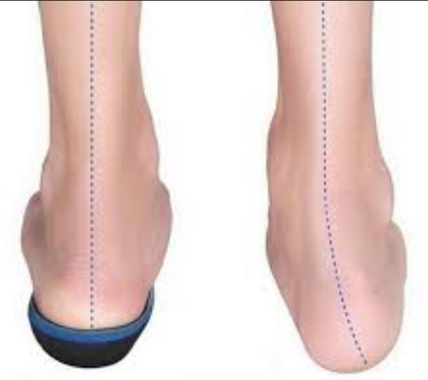 Shoe Gear and Orthotics